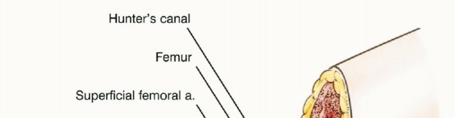 Illustration 22 for Anterior Flap Hemipelvectomy: Leveraging fig tech fig for Difficult Tumors