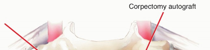 Illustration 16 for Stop Numbness & Instability: Corpectomy and Fusion Guide