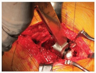 Illustration 14 for Uncemented Acetabular Revision: Optimizing Hemispherical Cup Use