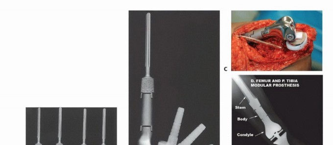 Illustration 12 for Distal Femoral Replacement: Key to Modern Limb Salvage