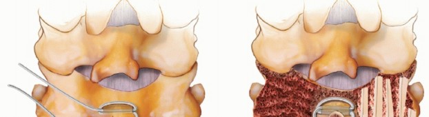 Illustration 7 for Achieve Stability: Posterior Cervical Lateral Mass Screw Fusion