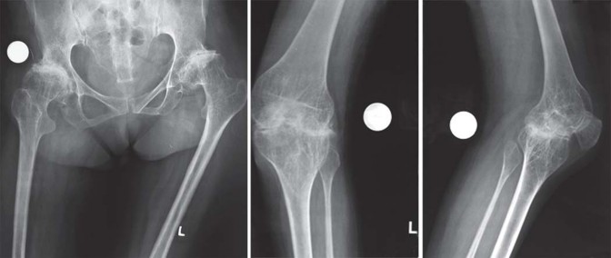 Illustration 42 for Total Hip Arthroplasty: Restoring Mobility in Juvenile Idiopathic Arthritis