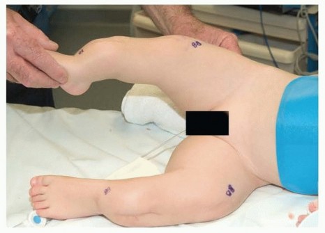 Illustration 11 for Less Pain, More Function: Fassier-Duval Nailing for Osteogenesis Imperfecta