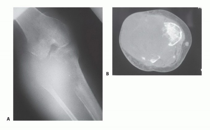 Illustration 12 for Mastering Above-Knee Amputation: Essential Surgical Insights