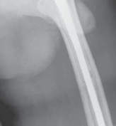 Illustration 4 for Advanced Arthroplasty for Malignant Lesions: Reclaim Your Mobility