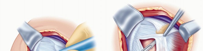 Illustration 22 for Bankart Repair & Inferior Capsular Shift: Solving Shoulder Instability
