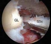 Illustration 26 for Arthroscopic Subscapularis Repair: The lo iky brady Method for Stability