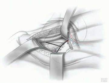 صورة توضيحية لـ النهج الأمامي لاستبدال مفصل الورك الكلي: ثورة في جراحة الورك مع الأستاذ الدكتور محمد هطيف في صنعاء