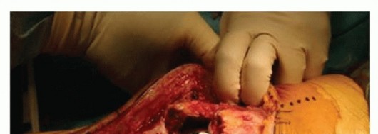 Illustration 3 for Patella Tendon Rupture Reconstruction in Revision TKA