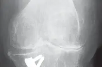 محاذاة مكونات عظم الساق في جراحة استبدال الركبة الكلي: دليل شامل لتحقيق أفضل النتائج مع الأستاذ الدكتور محمد هطيف في صنعاء