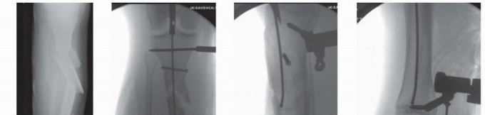 Illustration 31 for Advanced Nailing of the Mature Tibia: Overcoming Complexities