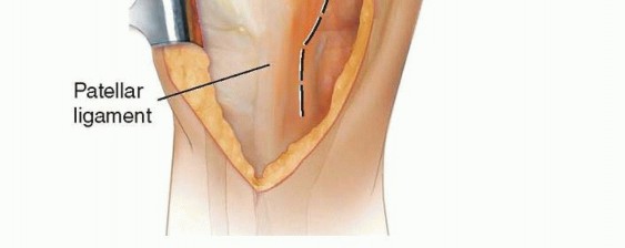 Illustration 2 for Master Extensile Exposure with V-Y Quadricepsplasty