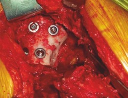 Illustration 14 for Revision THA: Acetabular Impaction Grafting for Severe Bone Loss