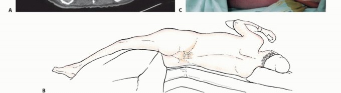 Illustration 13 for Pelvic Metastasis Surgery: A Component of the Utilitarian Approach