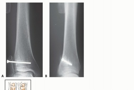 Illustration 39 for Beyond Amputation: The Type I Resection in Fibular Tumor Surgery