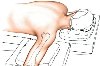 Illustration 2 for Mastering Elbow Approaches: Applied Surgical Anatomy for Precision