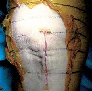 Illustration 27 for Minimally Invasive Subvastus: The Best Path to Quicker TKA Recovery