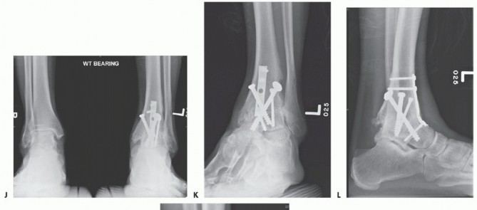 Illustration 25 for Optimize Pain Management with Proximal Ring Block for Ankle Arthrodesis