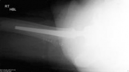 Illustration 8 for Hybrid Primary Total Hip: A Solution for Complex Joint Pain