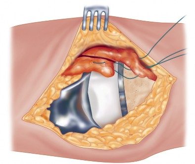 Illustration 37 for Precision Soft Tissue Balancing in Revision: Avoid TKA Pitfalls