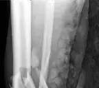 Distal Tibia Fracture Repair: Mastering Plating and Screws