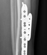 Illustration 23 for Complex Tibial Shaft Fracture: Plate Fixation for Plafond Extension