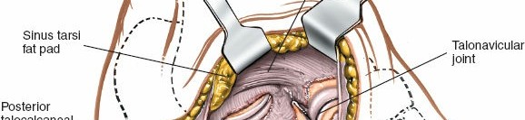 Illustration 113 for Optimized Approaches to the Dorsum of the Foot & Ankle