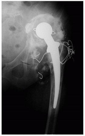 Illustration 5 for Uncemented Acetabular Revision: Optimizing Hemispherical Cup Use