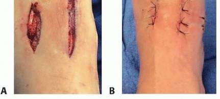Illustration 27 for Fixation of Lisfranc Injuries: Essential Open Reduction Guide