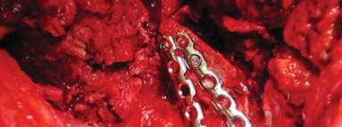 Illustration 20 for Management of Periprosthetic Fractures: An Expert Surgical Guide