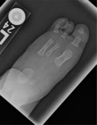 Fibular Deficiency (Hemimelia): Epidemiology, Classification, Anatomy & Biomechanics