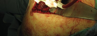 Illustration 62 for Figure Hip Resurfacing: Who Benefits and Who Should Avoid It?