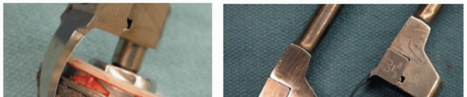 Illustration 7 for Mastering Component Removal: Extended Trochanteric Osteotomy