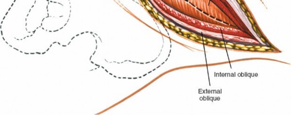 Illustration 14 for Master the Anterolateral Retroperitoneal Approach to Lumbar Spine