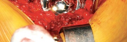 Illustration 67 for Birmingham Hip Resurfacing Designer's Technique for Active Lives