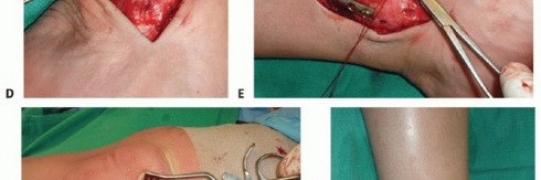 Illustration 33 for Painful Talus Lesions? The tech fig c Osteochondral Transfer Solution