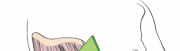 Illustration 12 for Unlocking Every Aspect of the Hip's Surgical Approaches