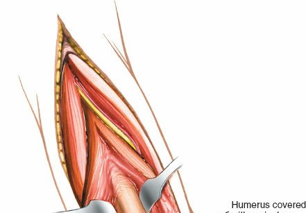 Illustration 46 for Mastering the Approach to the Distal Humerus: Safety & Skills