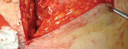 Illustration 3 for Femoral Stem Revision: Posterior Approach for Better Outcomes