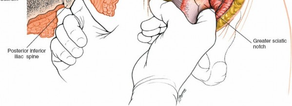 Illustration 14 for Simple & Safe Posterior Approach to the Sacroiliac: Key Techniques