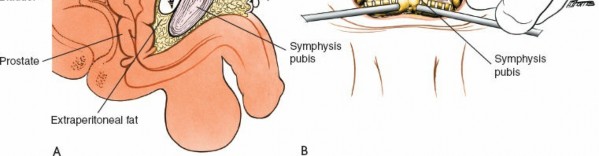 Illustration 13 for Mastering the Posterior Iliac Crest for Bone Graft Harvest
