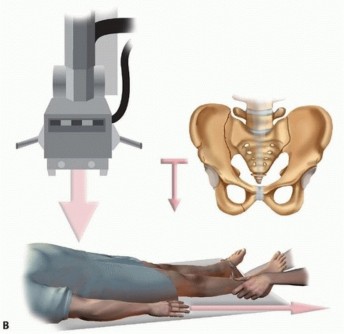 Illustration 6 for Emergency Fixation of the Pelvis: Control Bleeding & Restore Stability