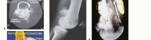 Illustration 40 for Understanding Benign Bone Tumors: Your Complete Preoperative Guide