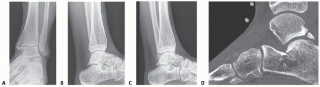 Posterior Talar Process: Endoscopic Solutions for Ankle Pain