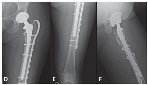 Illustration 8 for Mastering Fixation of Periprosthetic Fractures of the Femur