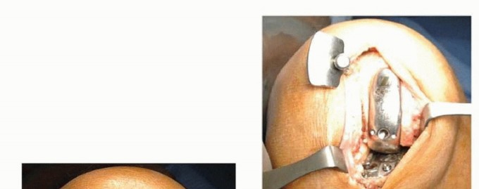 صورة طبية: استبدال مفصل الركبة الجزئي: حل متقدم لآلام الركبة المستمرة مع الأستاذ الدكتور محمد هطيف