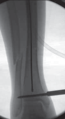 Illustration 25 for Optimal Nailing of the Tibia: Techniques for Challenging Fractures