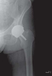 Illustration 81 for Metal on Metal Resurfacing: Enhanced Posterior Soft Tissue Repair