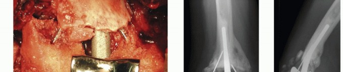 Illustration 30 for Distal Humeral Fractures: When Is Elbow Replacement the Best Option?