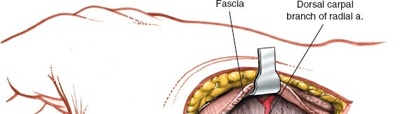 Illustration 194 for Essential Surgical Approaches: Uncover Every Aspect of the Wrist